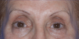 Botox Correction of Uneven Brows