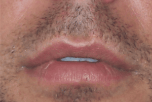 Restylane Lip Filler