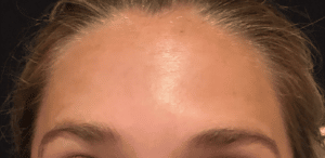 Botox Forehead Lines