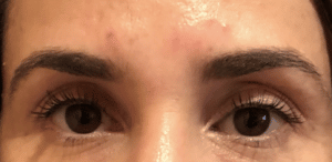 Botox Brow Lift