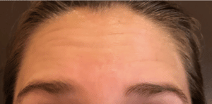 Botox Forehead Lines