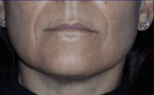 Restylane Smile Lines and Lips