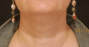 Ultherapy Neck Lines