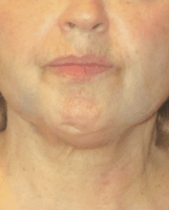 Ultherapy Lower Face Lift