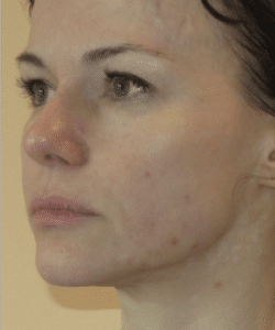 Ultherapy Lower Face