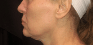 Ultherapy Lower Face and Neck