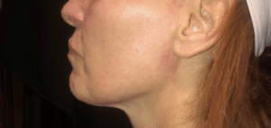 Ultherapy Jowl Lift