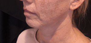 Ultherapy Lower Face and Neck