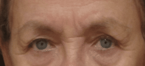 Ultherapy Brow Lift
