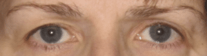 Ultherapy Eyebrow Lift