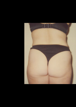 Endermologie – Case 5