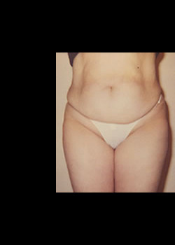Endermologie – Case 8