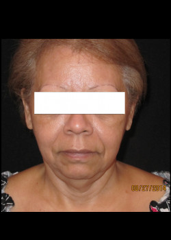 Ultherapy- Case 5