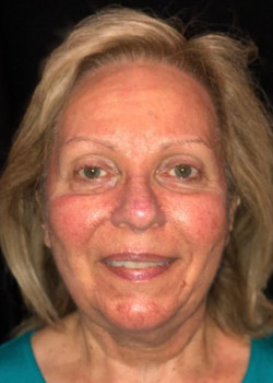 Ultherapy Full Face Results