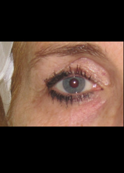 Ultherapy Brow Lift