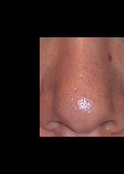 Invisilift Nose Pores